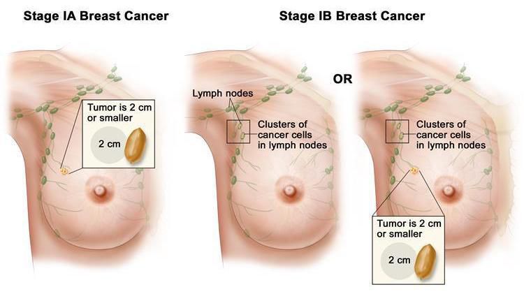 Breast cancer stage iia